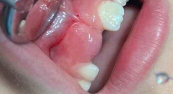 Dentizione