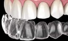 invisalign