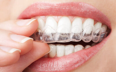 Invisalign