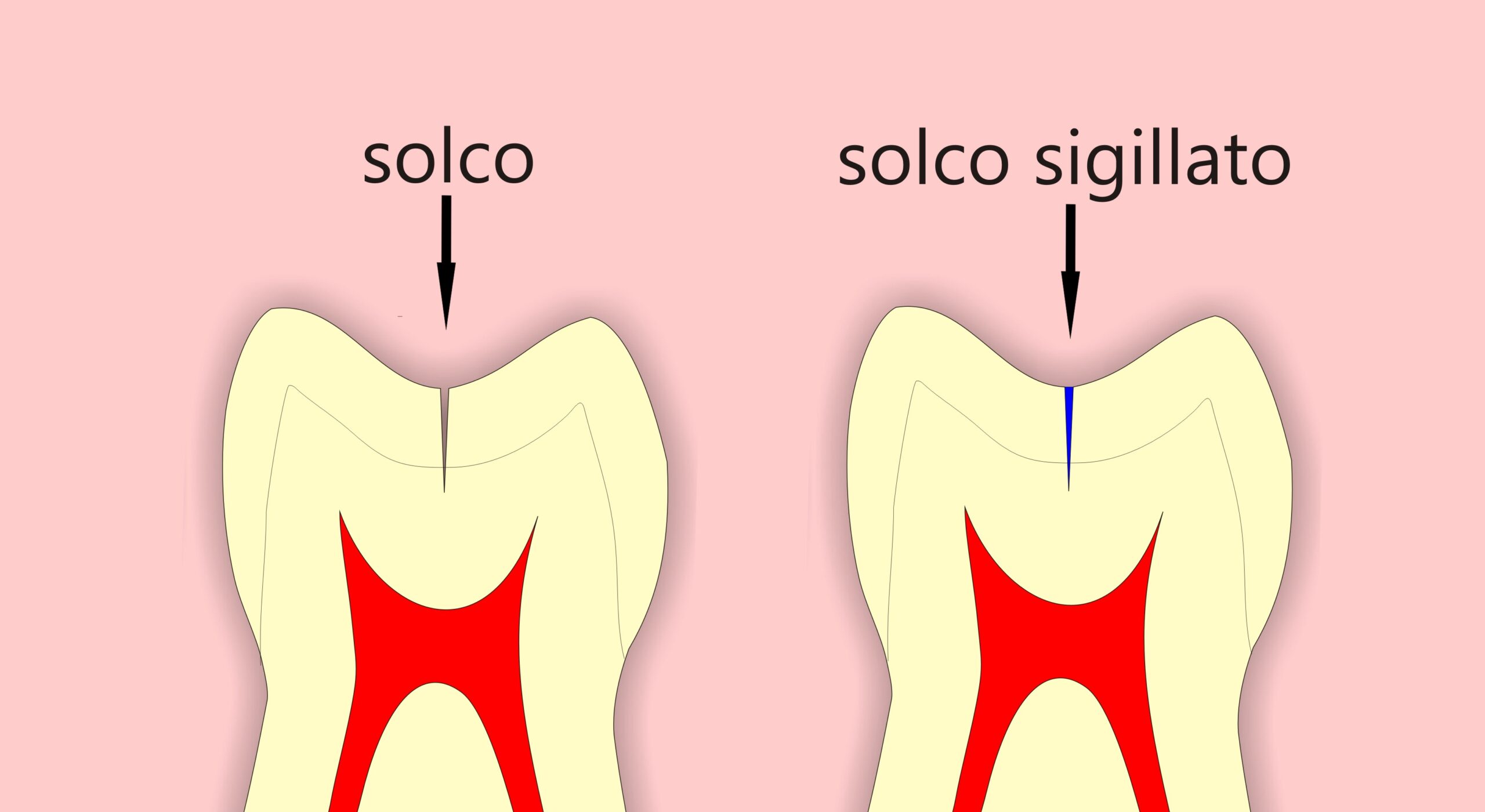 sigillatura del solco denti