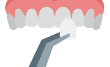 Faccette Dentali