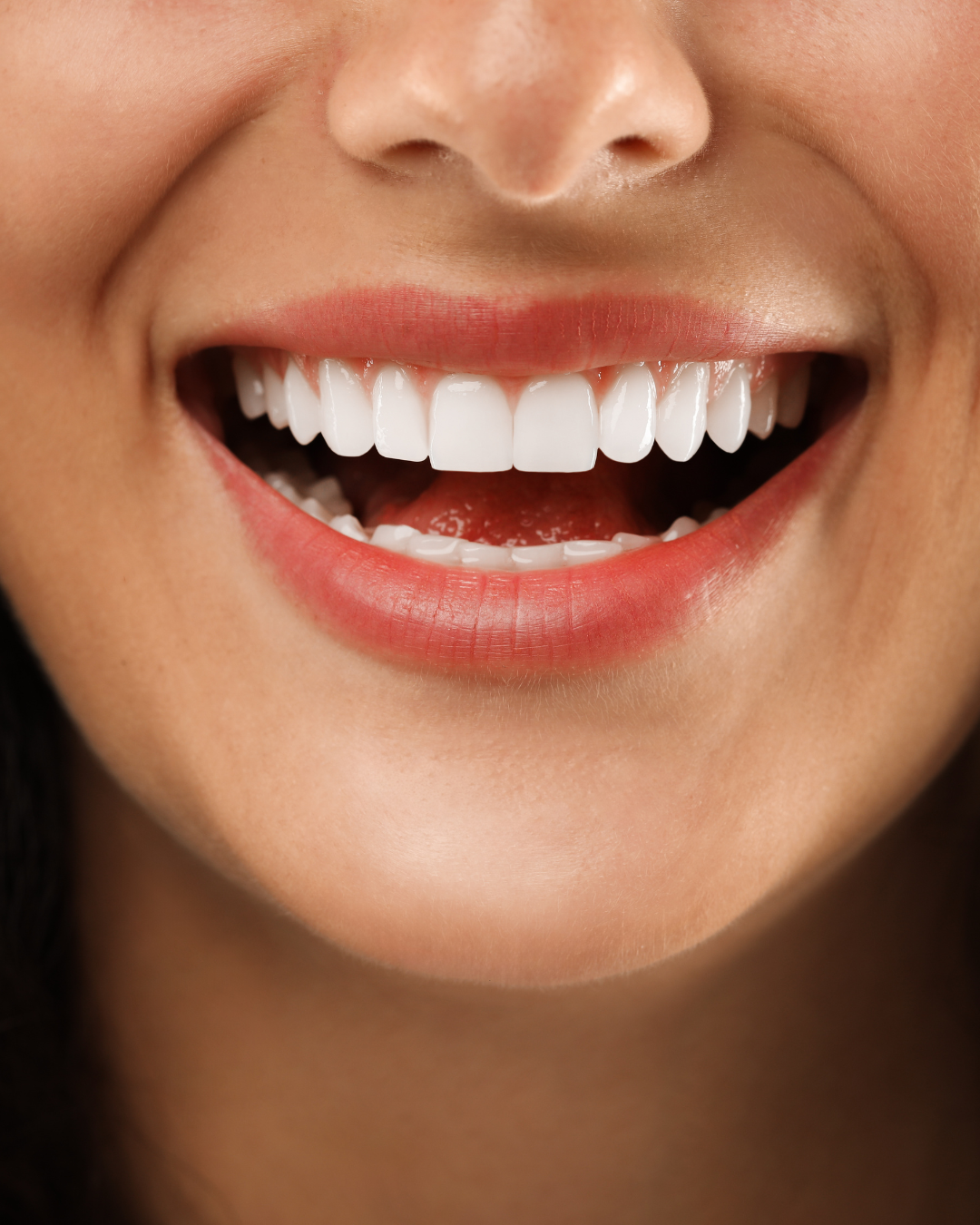 faccette dentali roma