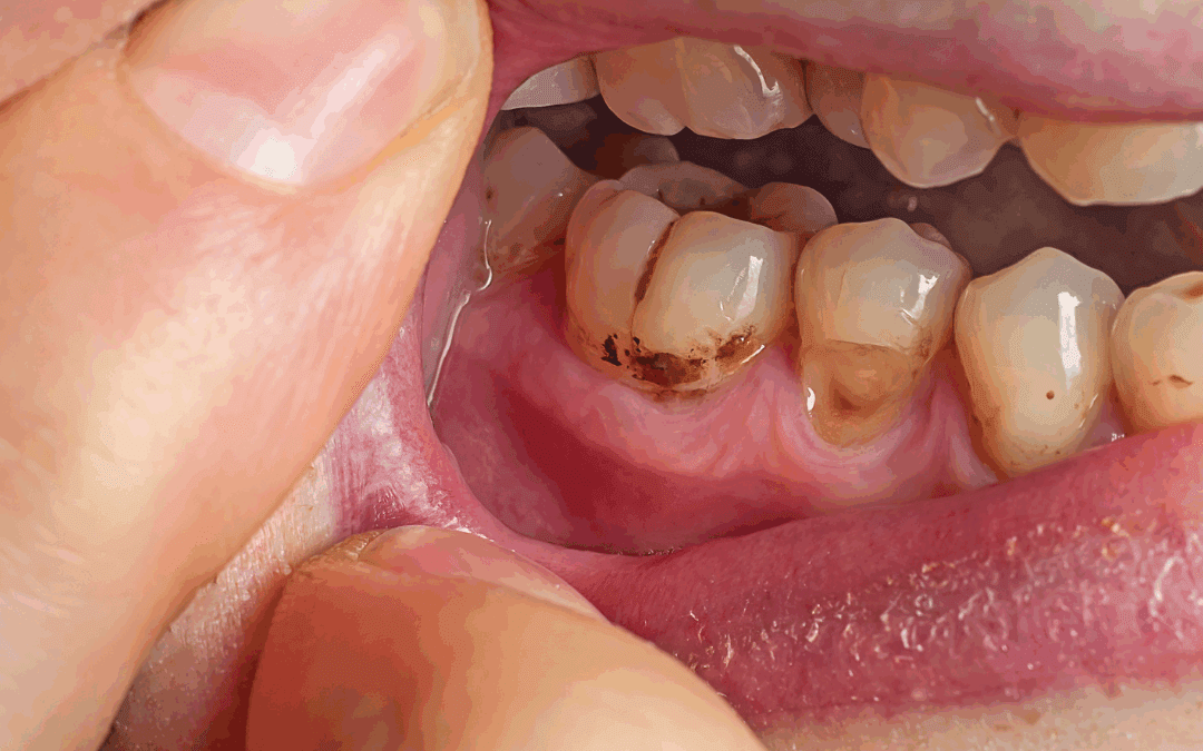 5 abitudini sbagliate che stanno danneggiando i tuoi denti