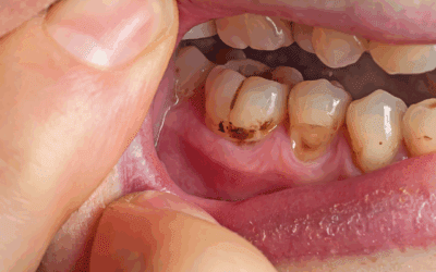 5 abitudini sbagliate che stanno danneggiando i tuoi denti