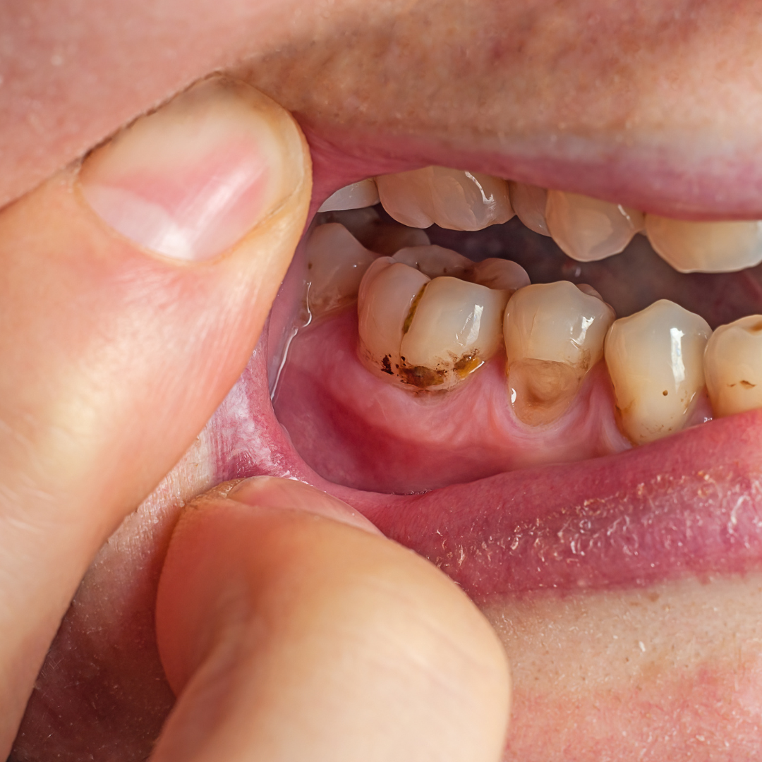 bad teeth